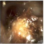 Before Wax Removal - The Audiology Place before wax removal ear wax removal before and after the audiology place