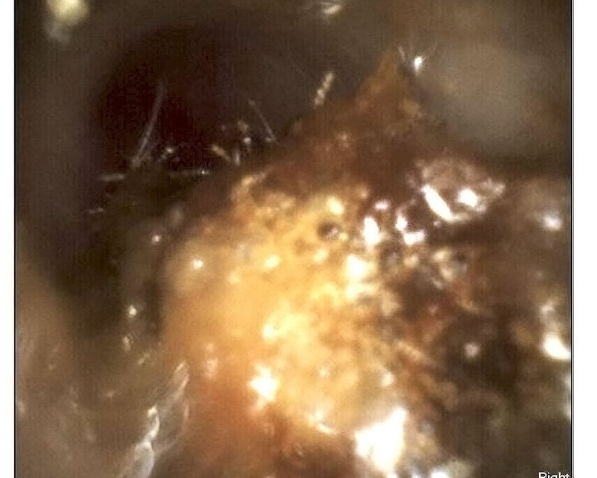  before wax removal ear wax removal near me why choose a professional over diy methods   the audiology place