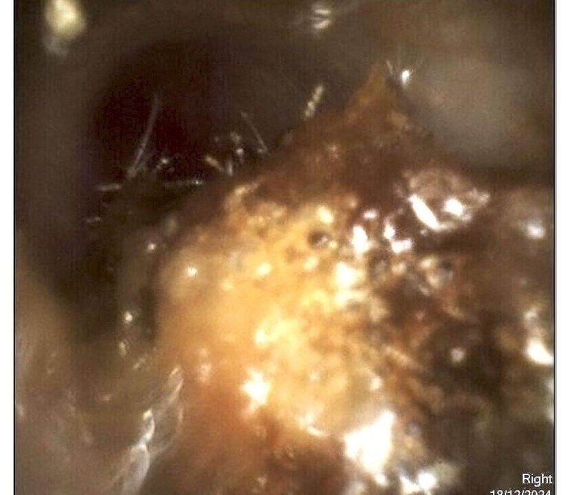  before wax removal ear wax removal near me why choose a professional over diy methods   the audiology place